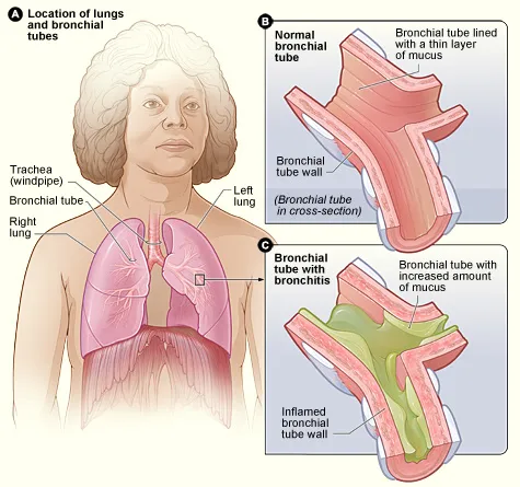 Figure A shows the location of the lungs and bronchial tubes in the body. Figure B is an enlarged, detailed view of a normal bronchial tube. Figure C is an enlarged, detailed view of a bronchial tube with bronchitis. The