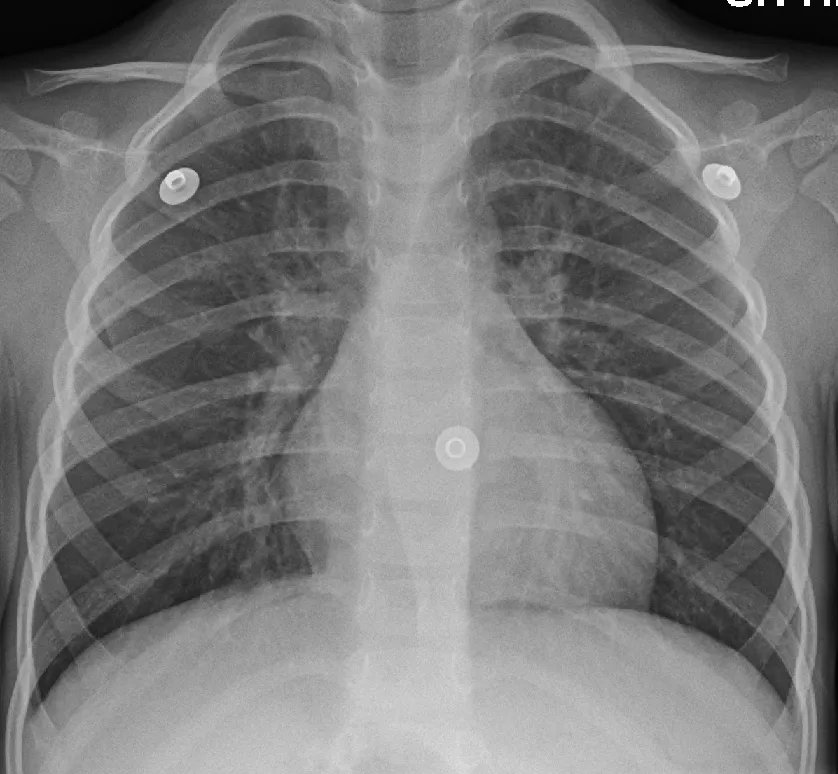 Mild peri hilar cuffing as seen in a viral bronchitis