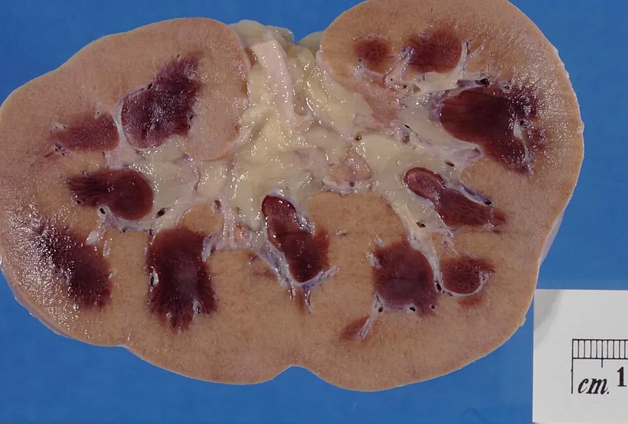 Kidney showing marked pallor of the cortex, contrasting to the darker areas of surviving medullary tissue.