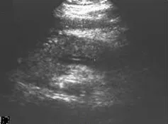 Ultrasonography of acute pancreatitis, showing a bulky hypoechoic organ.