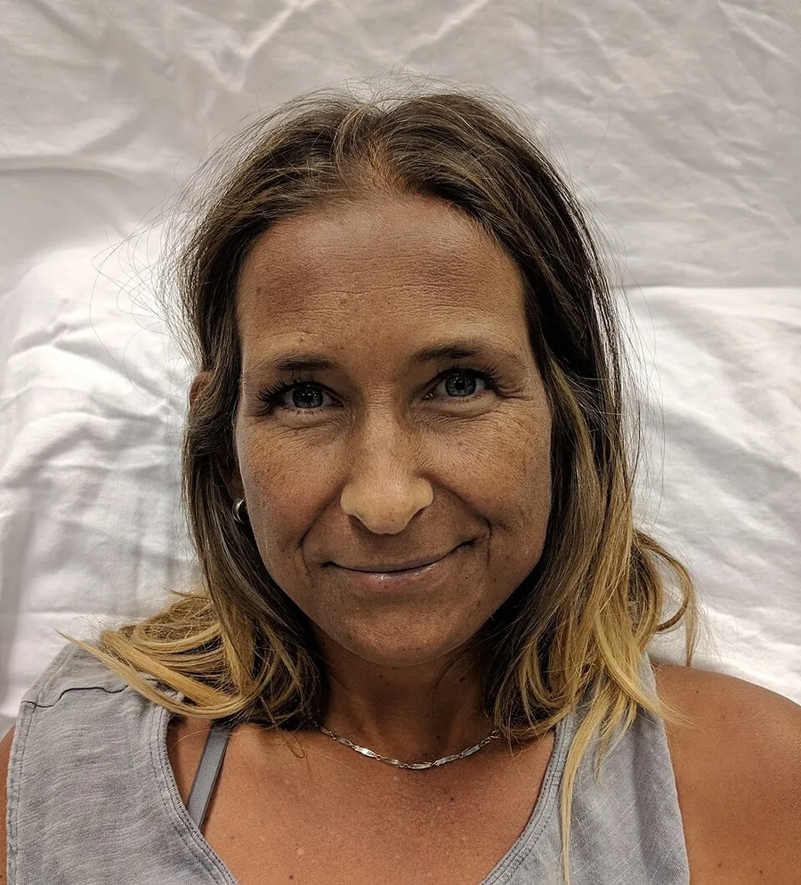 A Caucasian woman with Addison's disease