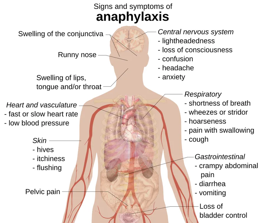 Signs and symptoms of anaphylaxis. References and further description is found at: en:Anaphylaxis#Signs and symptoms