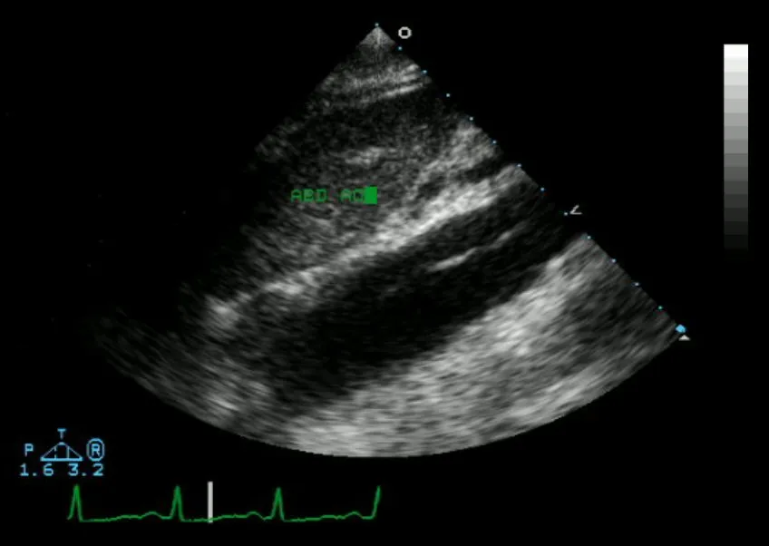 An echocardiogram of the descending aorta (in longitudinal view) displaying an aortic dissection.