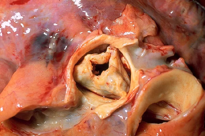 Gross pathology of rheumatic heart disease: aortic stenosis. Aorta has been removed to show thickened, fused aortic valve leaflets and opened coronary arteries from above. Autopsy.