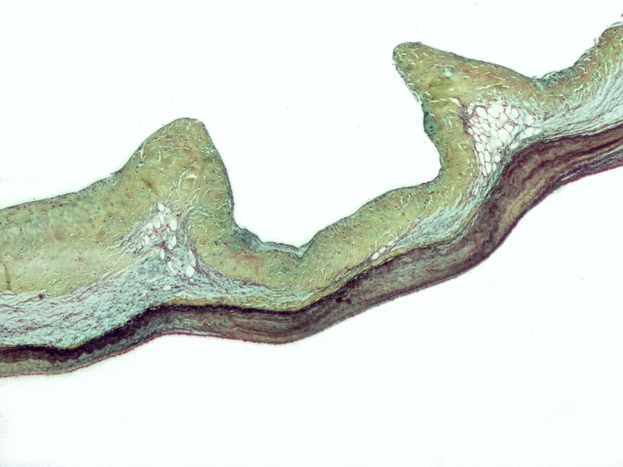 Micrograph of myxomatous degeneration of the aortic valve. Surgical specimen. Movat's stain (Black = nuclei, elastic fibres. Yellow = collagen, reticular fibers. Blue = ground substance, mucin. Bright red = Fibrin. Red =