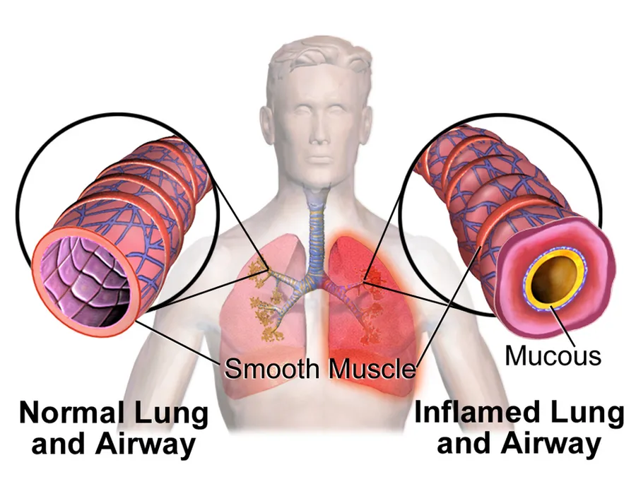 Asthma.