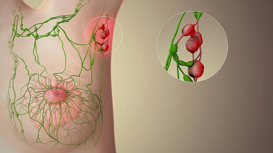 Lymph nodes may become enlarged due to an infection, injury and cancer.