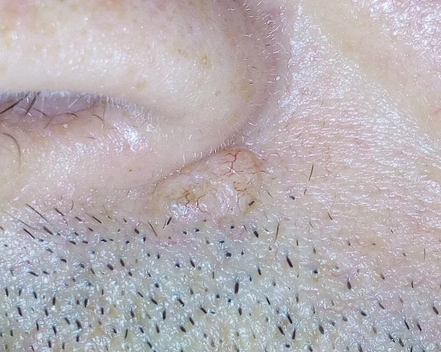 Basal cell carcinoma