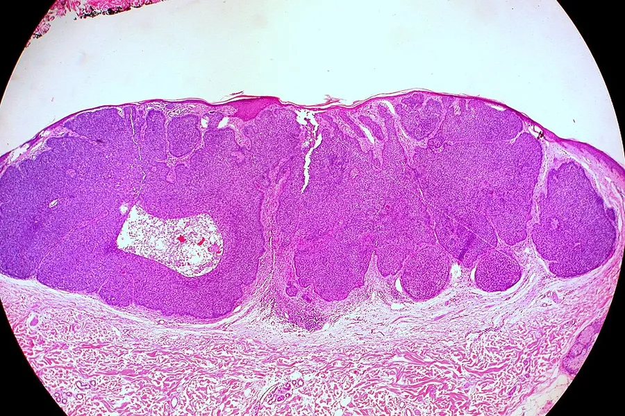 Basal Cell Carcinoma, Nodular Pattern Pathological and histological images courtesy of Ed Uthman at flickr.