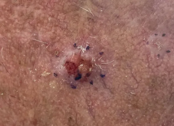 Basal Cell Carcinoma, Right cheek marked for biopsy