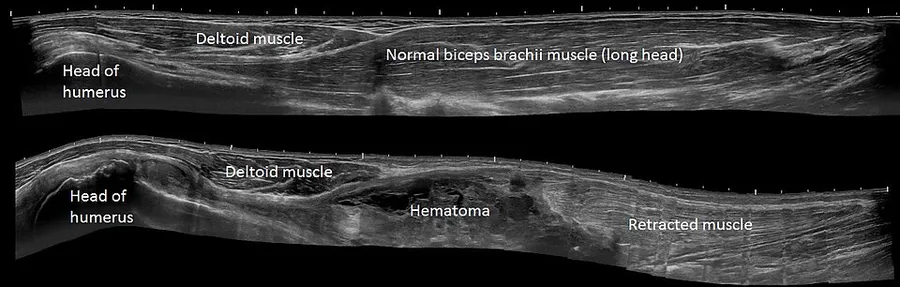 Panoramic ultrasonography of a biceps tendon rupture in a 53 year old man who had been woodcutting. Upper image is a normal (left) upper arm, and lower is the afflicted arm.