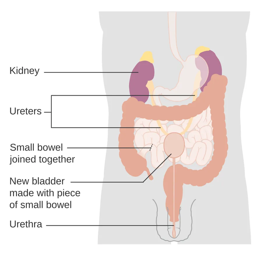 Diagram showing bladder reconstruction.