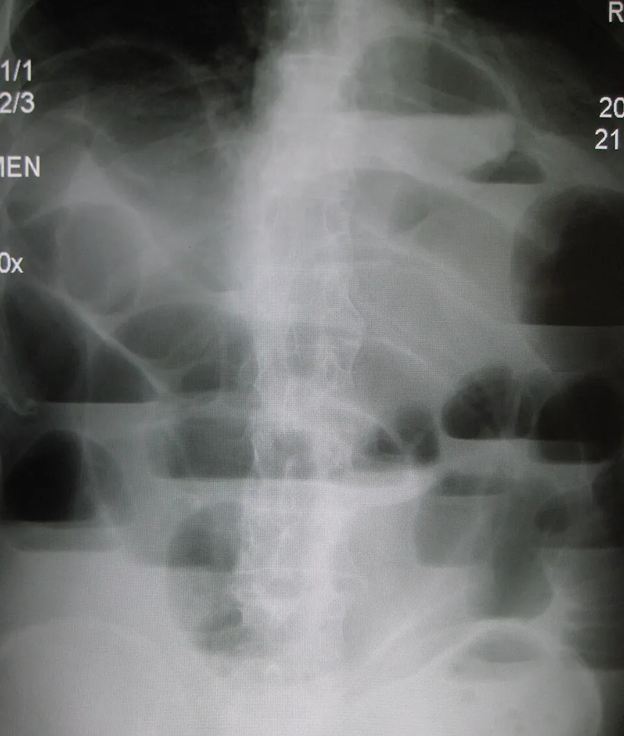 An upright Xray demonstrating a small bowel obstruction (multiple air fluid levels).