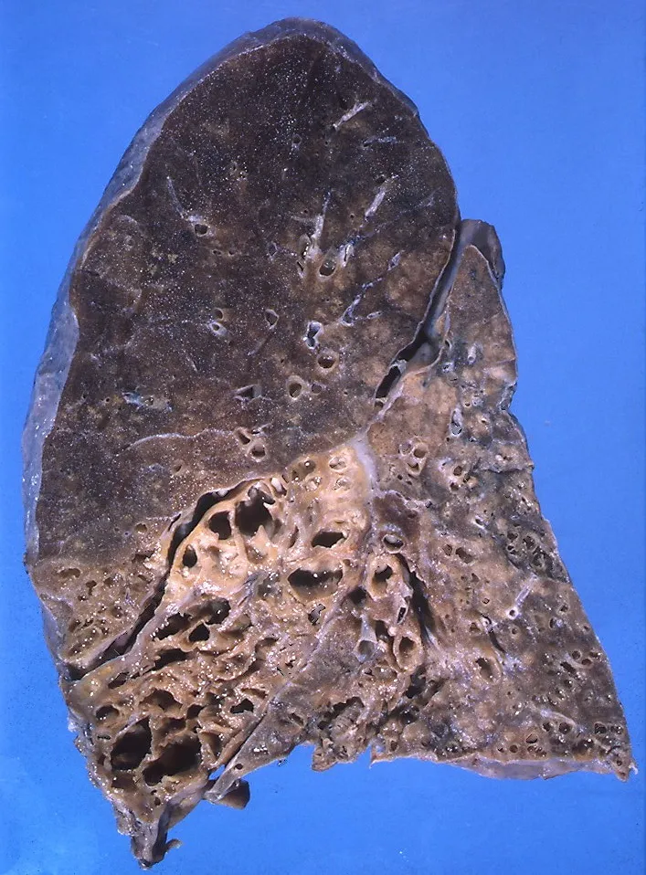 Bronchiectasis