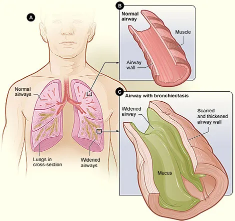 Figure A shows a cross-section of the lungs with normal airways and widened airways. Figure B shows a cross-section of a normal airway. Figure C shows a cross-section of an airway with bronchiectasis.