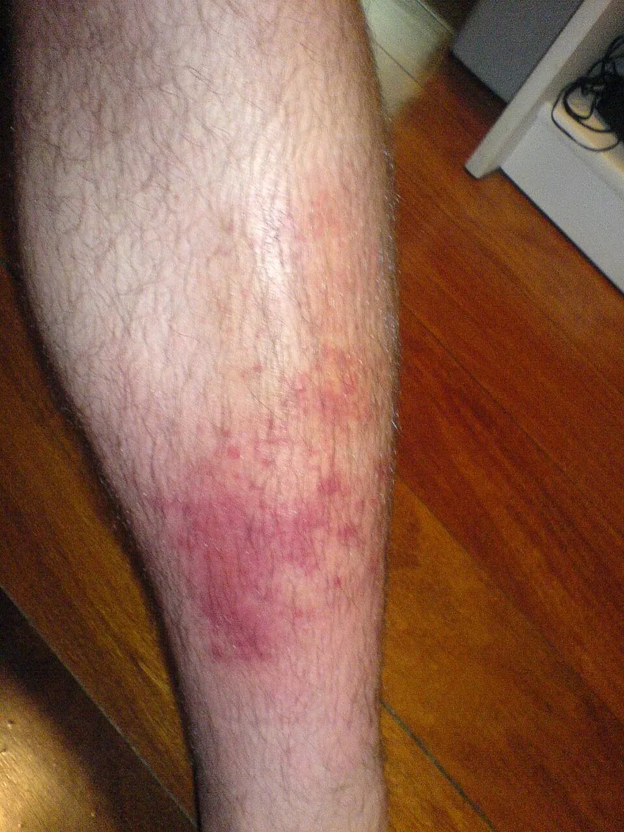 Cellulitis case, my left knee infected