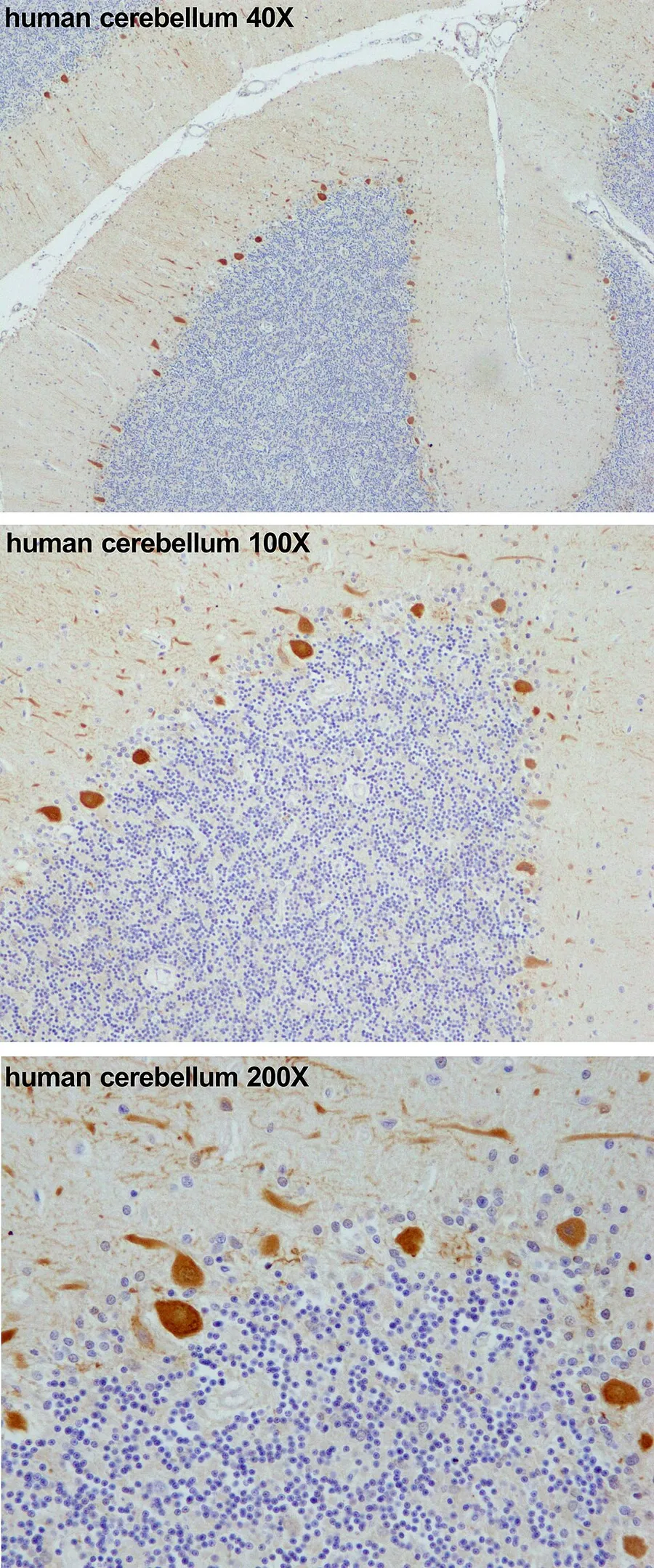 The Purkinje cell protein 4 (PCP4) is markedly immunoreactive in the Purkinje cells of the human cerebellum. From top to bottom 40X, 100X and 200X microscopic magnifications. The immunohistochemistry was performed using