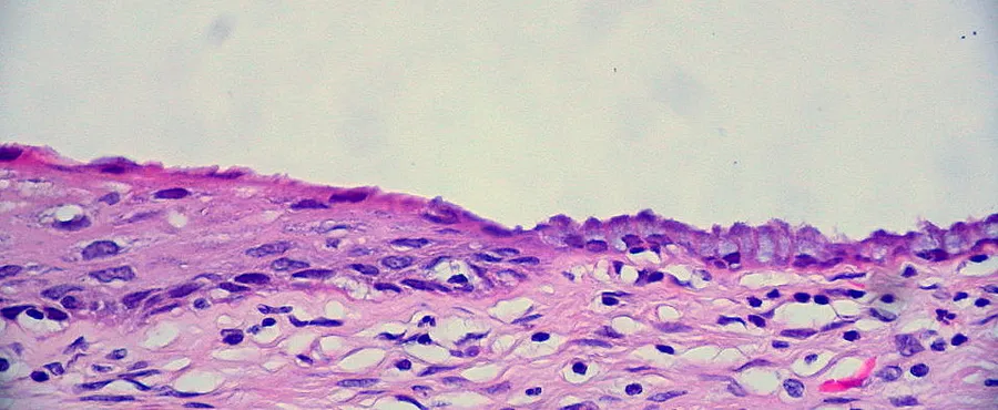 An unusually "clean" squamocolumnar junction of the uterine cervix, representing the boundary between the exocervix on the left, and the endocervix on the right. This is the "hot spot" where the tiny seedlings of dysplas