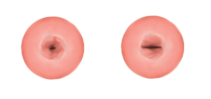 The cervix as it is seen pre vaginal delivery (left), with a rounded os, and post vaginal delivery (right), with a linear or horizontal os.