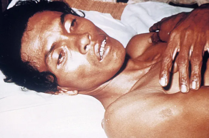Adult cholera patient with "Washer Woman's Hand" sign. Due to severe dehydration, cholera manifests itself in decreased skin turgor, which produces the so-called "Washer Woman's Hand" sign.