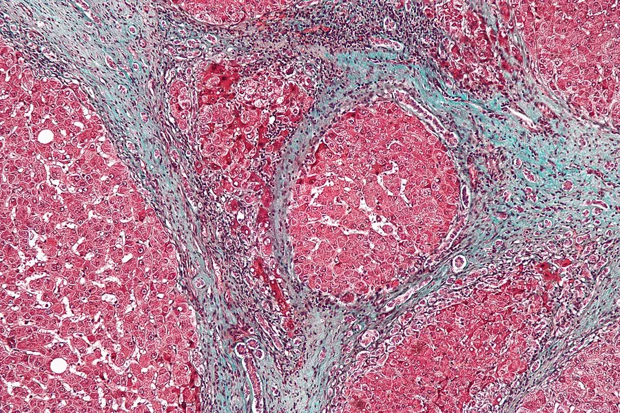 High magnification micrograph of a liver with cirrhosis. Trichrome stain. The most common cause of cirrhosis in the Western world is alcohol abuse - the cause of cirrhosis in this case.
