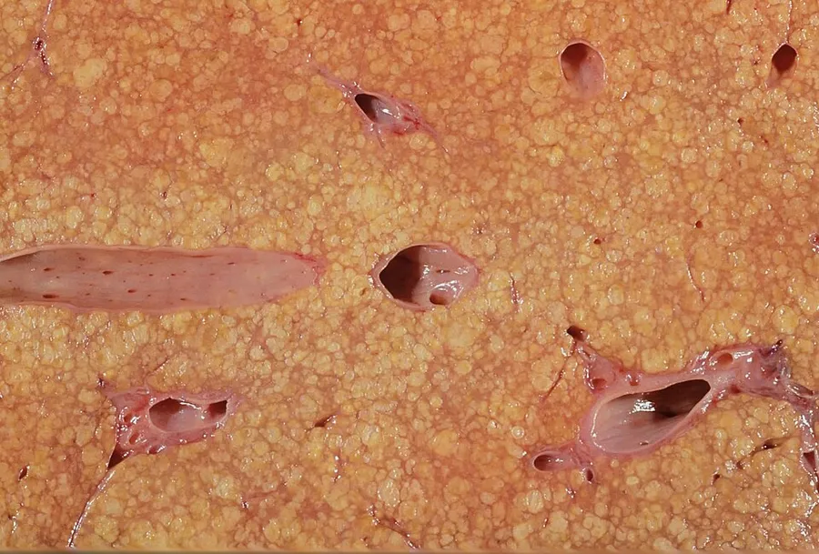 showing nodules of regenerating liver parenchyma with fibrous bands linking portal areas