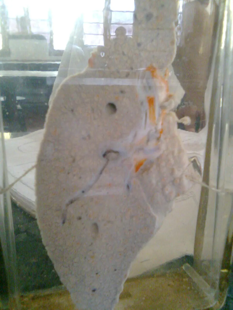 Cut section of the liver showing cirrhosis
