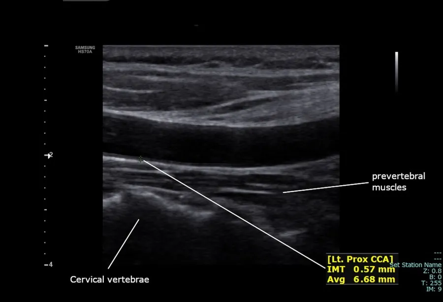 Left proximal common carotid artery intimal thickness