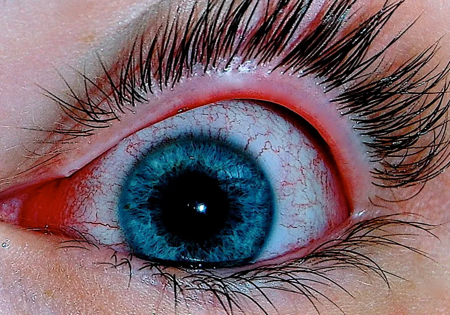 An eye infected with viral conjunctivitis