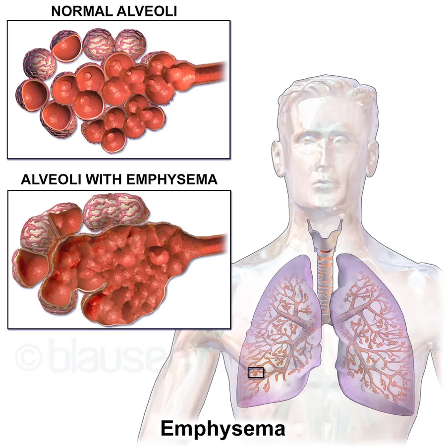 Emphysema.