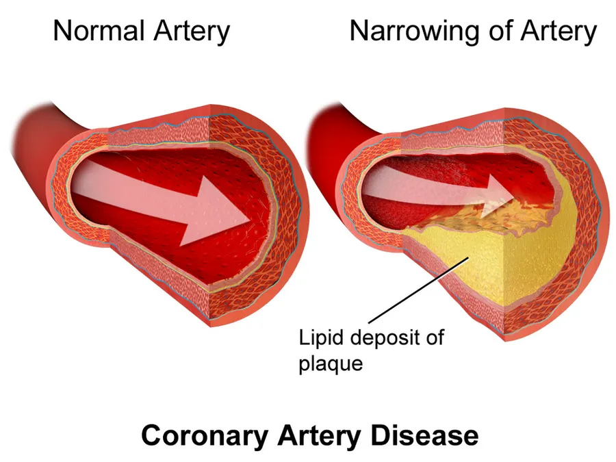 Coronary Artery Disease.