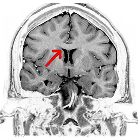 Coronal T2 (grey scale inverted) MRI of the brain at the level of the the caudate nuclei emphasizing corpus callosum. Image from Radiopaedia.org Whole brain T2 and inverted grey scale available here