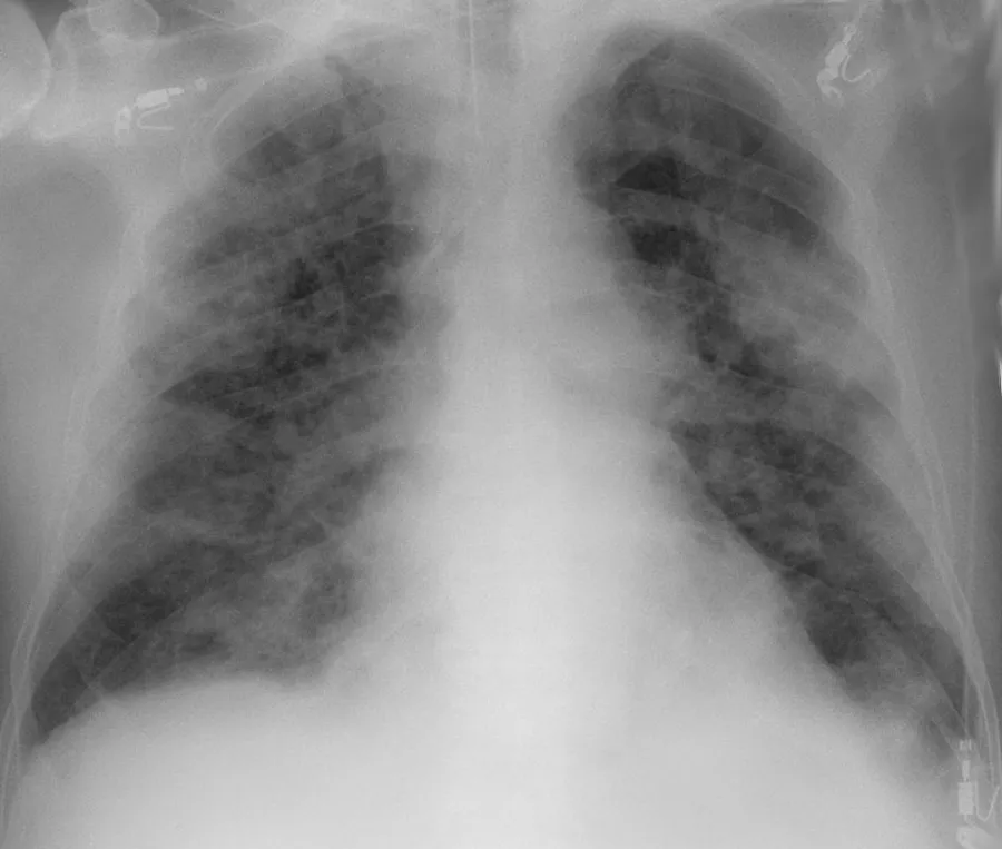 Chest X-ray in COVID-19 pneumonia