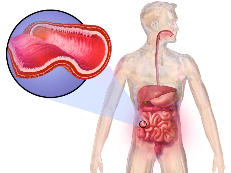 Medical illustration of Crohn's Disease.