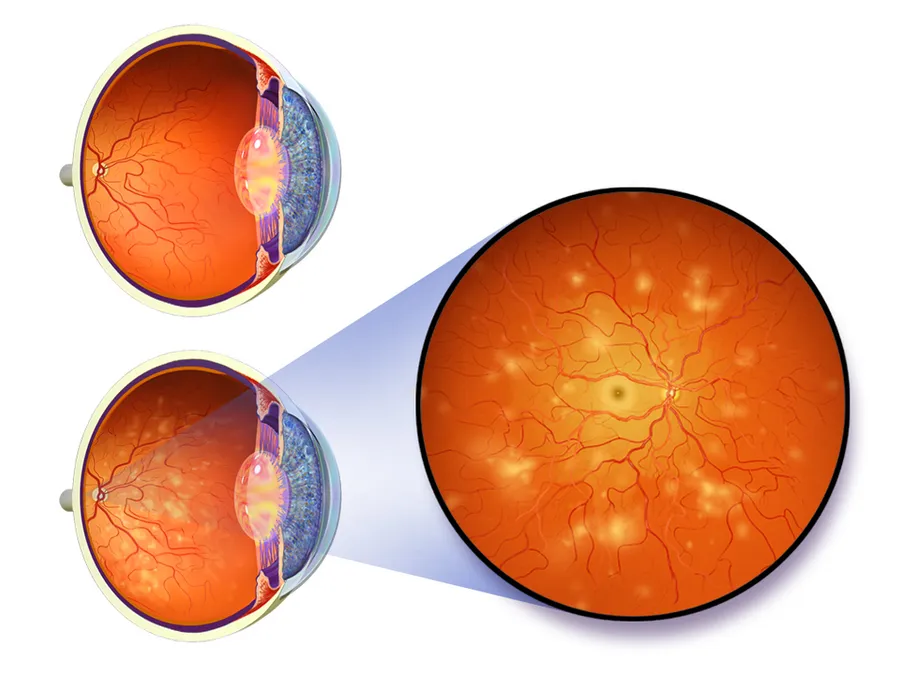 Diabetic Retinopathy.