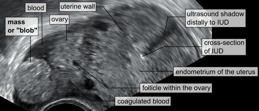 Vaginal ultrasonography image of a blob sign of ectopic pregnancy. Case description The otherwise healthy 31 year old woman had begun to feel symptoms of pregnancy, including breast tenderness. A urine pregnancy was posi