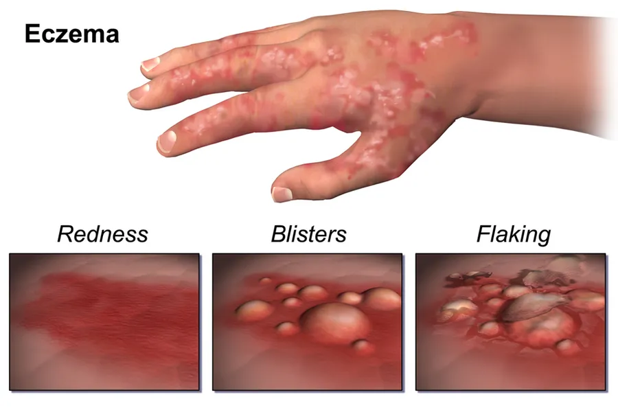 Eczema.