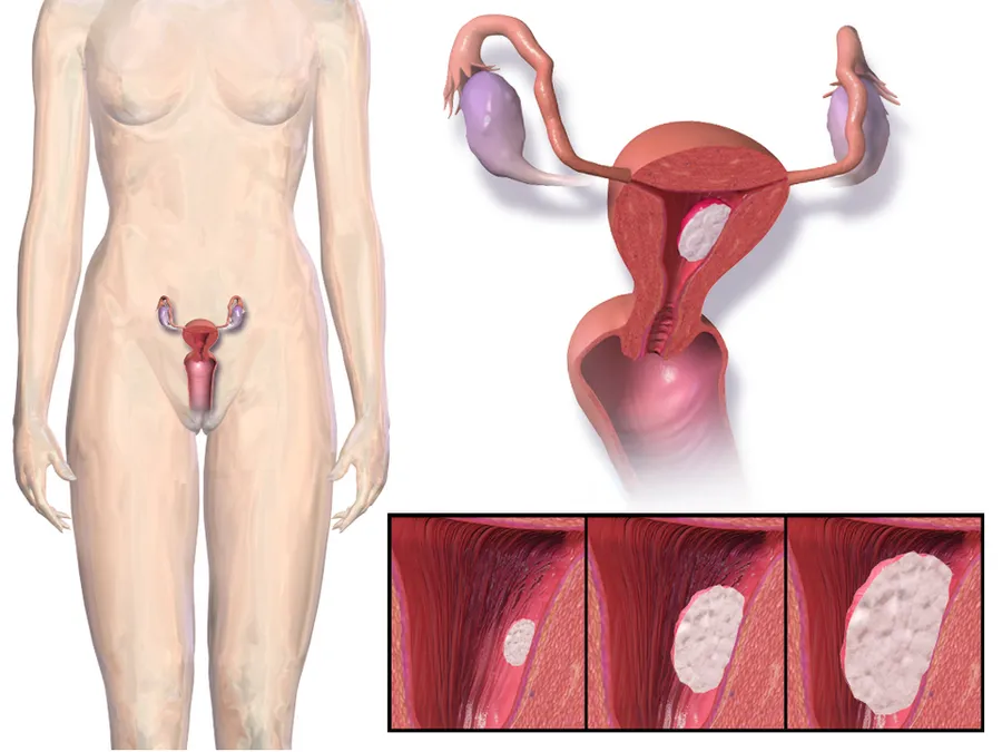 Endometrial Cancer.