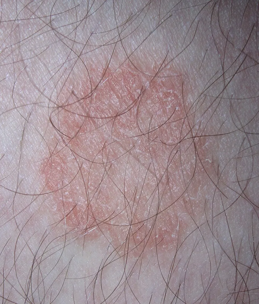 Dermatophytosis or ringworm with mildly raised border and central clearing