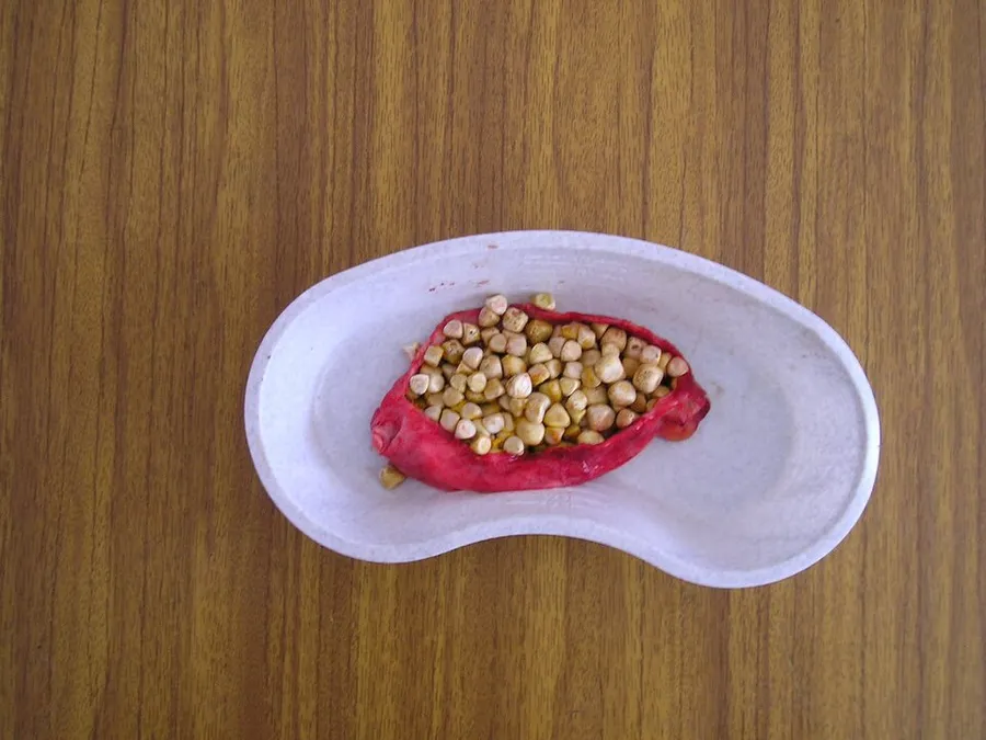 Gallstones in a cut gall bladder. Most likely cholesterol stones as these have a yellow color.