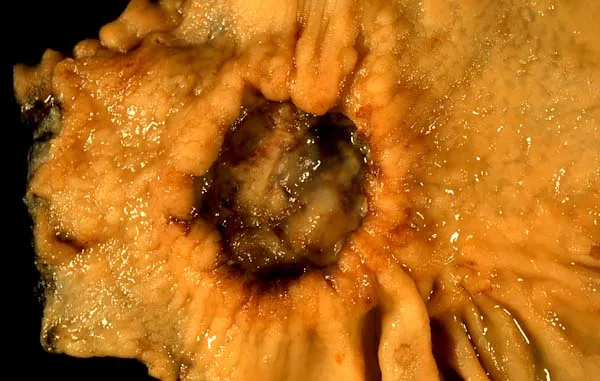 This cancer presented in a 40-year-old woman complaining of abdominal pain. Endoscopically it was a "very suspicious" ulcer. Biopsy showed diffusely infiltrating signet ring cell adenocarcinoma. These are gross photos of