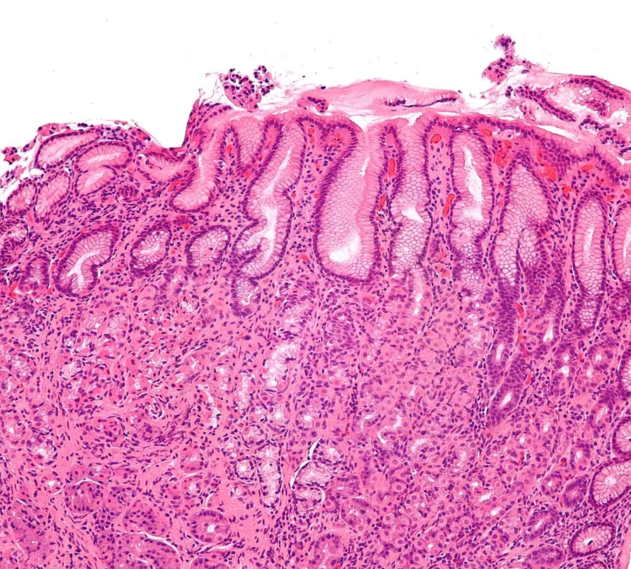 Intermediate magnification micrograph of gastritis with Helicobacter pylori. H&E stain. Related images Intermed. mag. High mag. Very high mag. Very high mag. (cropped)