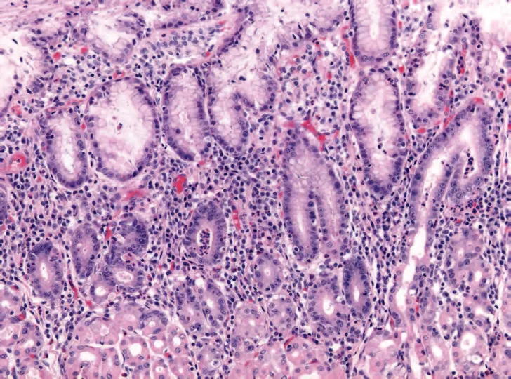 Histopathology of early acute superficial gastritis. Marked neutrophilic infiltrates appear in the mucous neck region and lamina with a pit microabscess, in this case secondary to H pylori. H&E 20x.