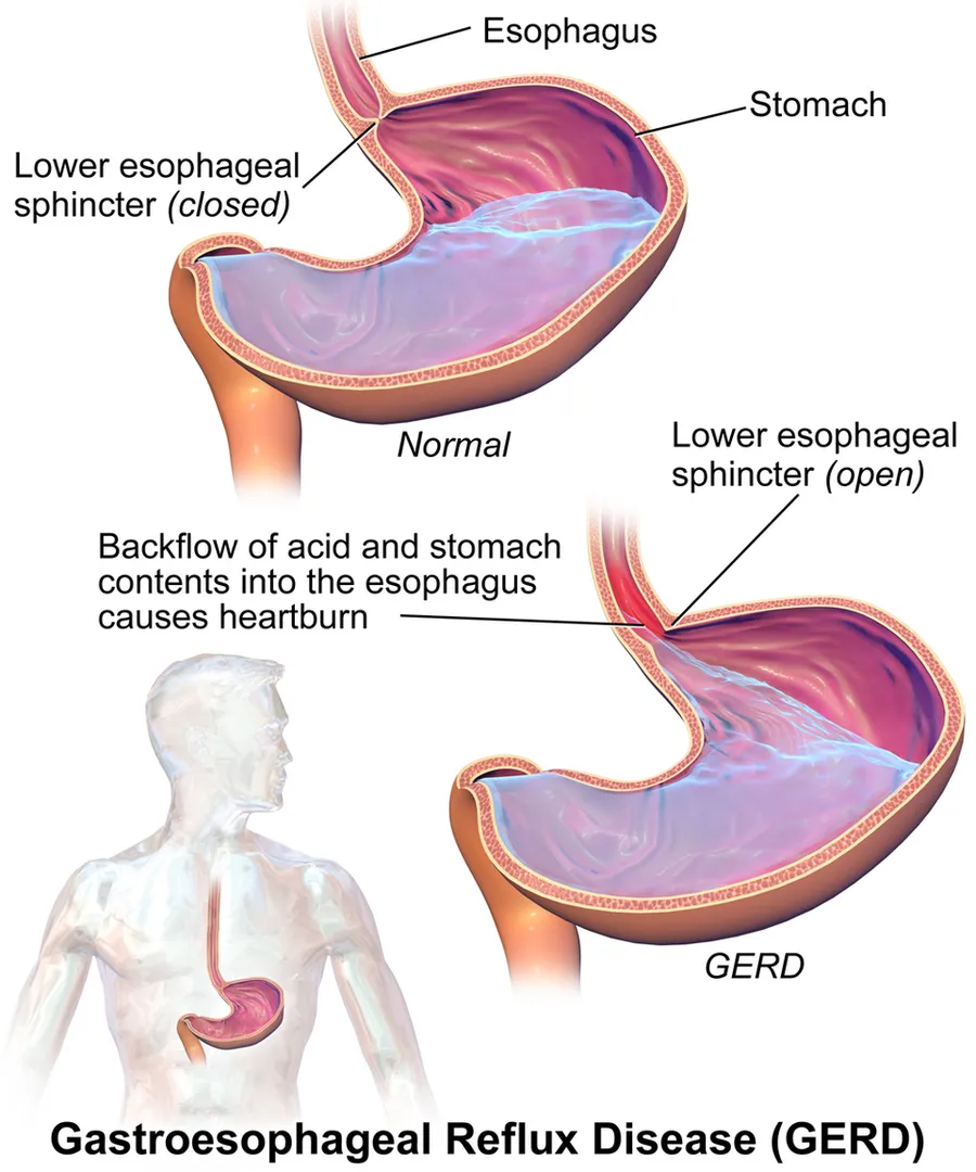 GERD.