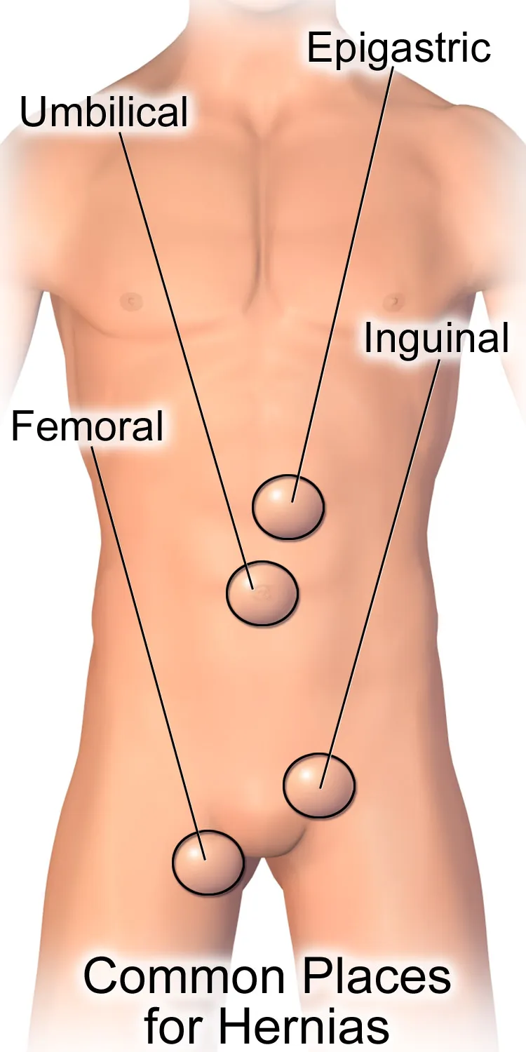 An illustration depicting common sites of a hernia.