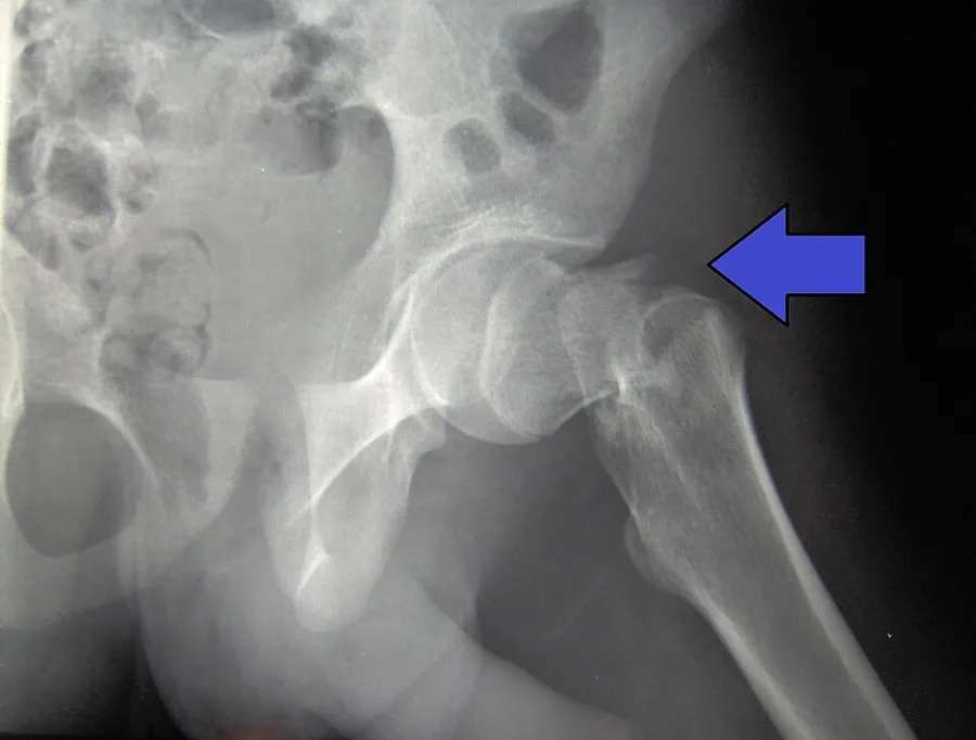 X-ray image of my own hip, with top of femur broken