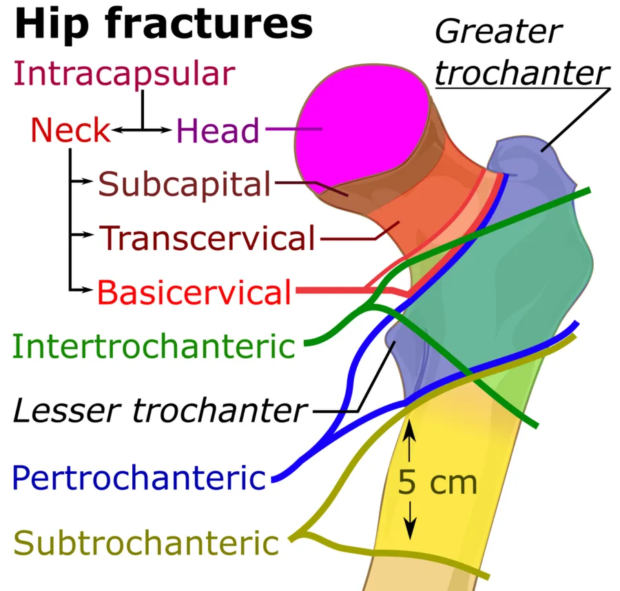 Classification of hip fractures.
