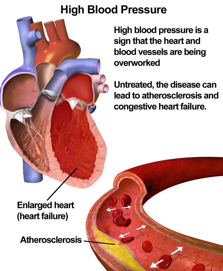 Hypertension (High Blood Pressure).