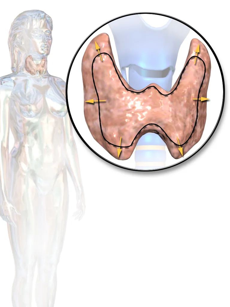 Hyperthyroidism.