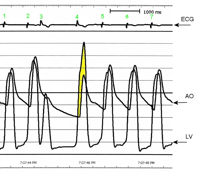 An intraventricular pressure tracing in an individual with hypertrophic cardiomyopathy, demonstrating dynamic outflow tract gradient